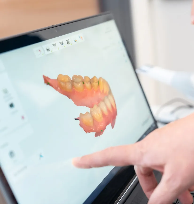 Escaneado digital en 3D de las arcadas de un paciente en el portátil de la clínica